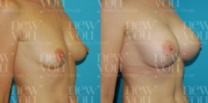 Brust Op Vorher nachher Bilder
