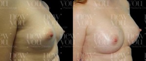 Brustvergrößerung Bilder Vorher Nachher