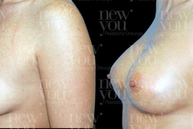 Brustvergrößerung Vorher Nachher Bilder Brustimplantate Fotos