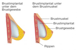 Die Platzierung der Implantate