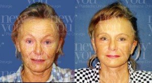 Facelifting Tschechien