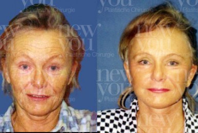Facelifting Tschechien