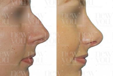 Rhinoplastik Vorher Nachher Prag