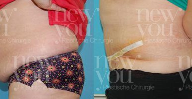 Bauchdeckenstraffung Vorher Nachher Prag
