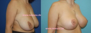 Brustverkleinerung Tschechien