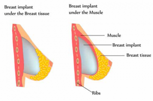 Wo liegen eigentlich die Brustimplantate