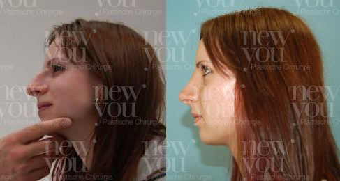 Frauen nachher nasenkorrektur vorher Nase Verkleinern