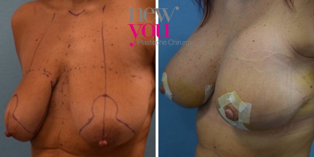 Bruststraffung mit Implantaten Vorher Nachher - Prag, Ausland, Tschechien